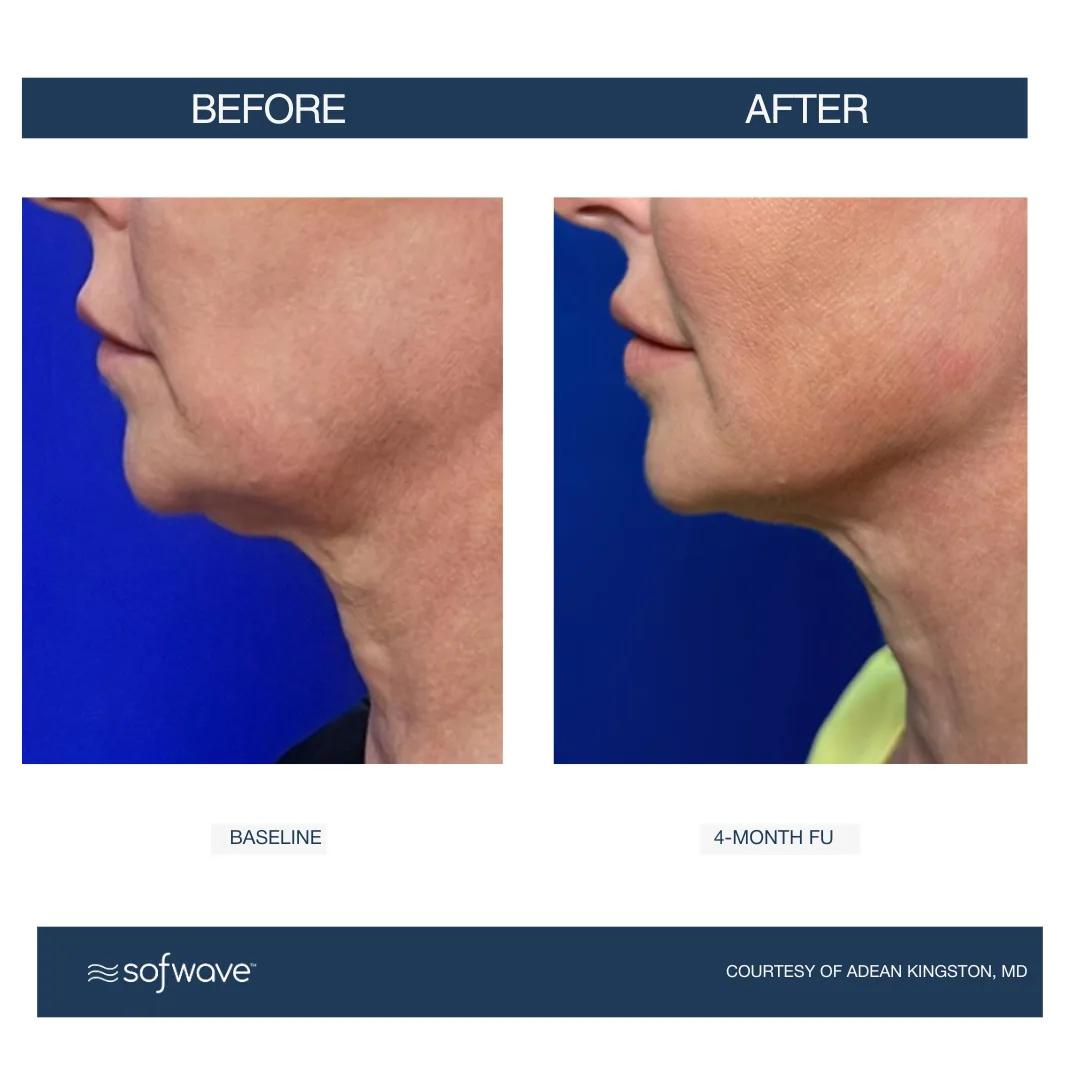 Sofwave™ Jawline & Under-Chin Lift