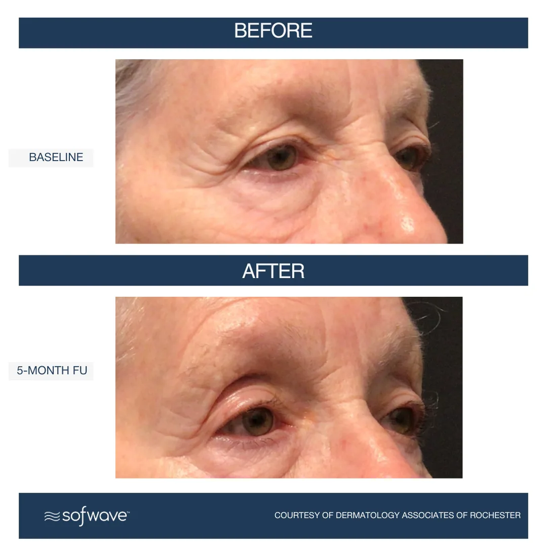 Sofwave™ Brow Lift