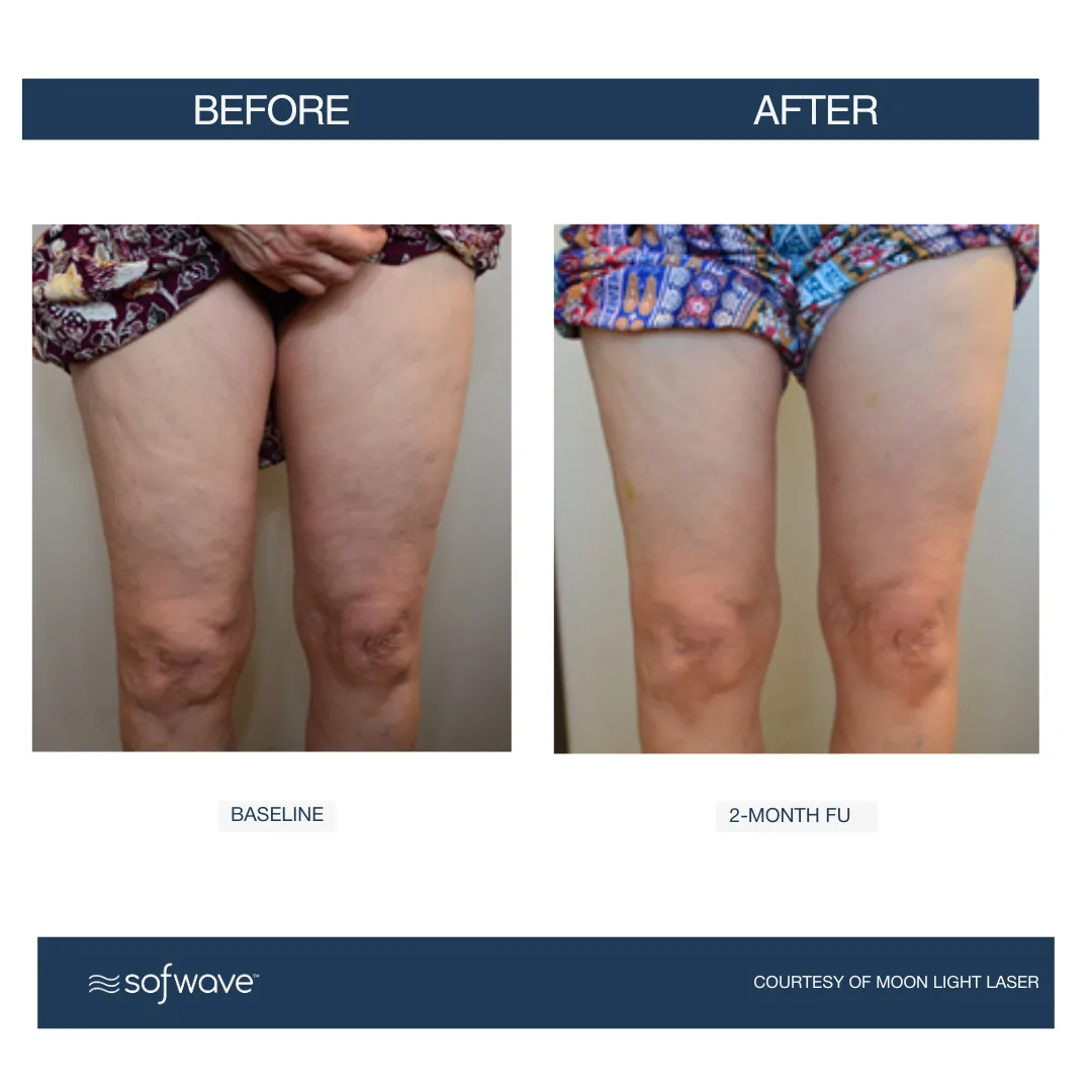 Sofwave™ Cellulite Smoothing