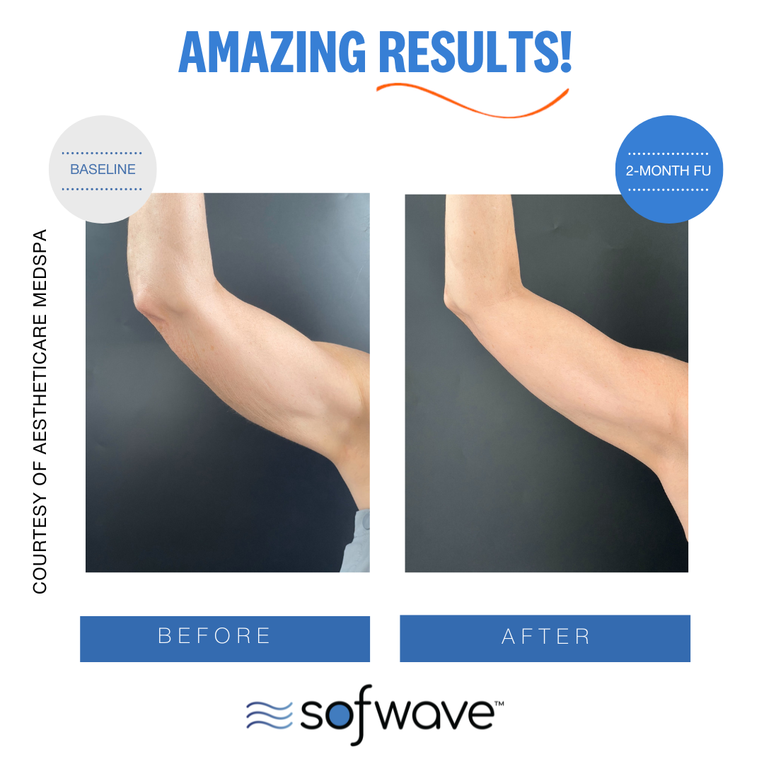 Sofwave™ Upper-Arm Firming